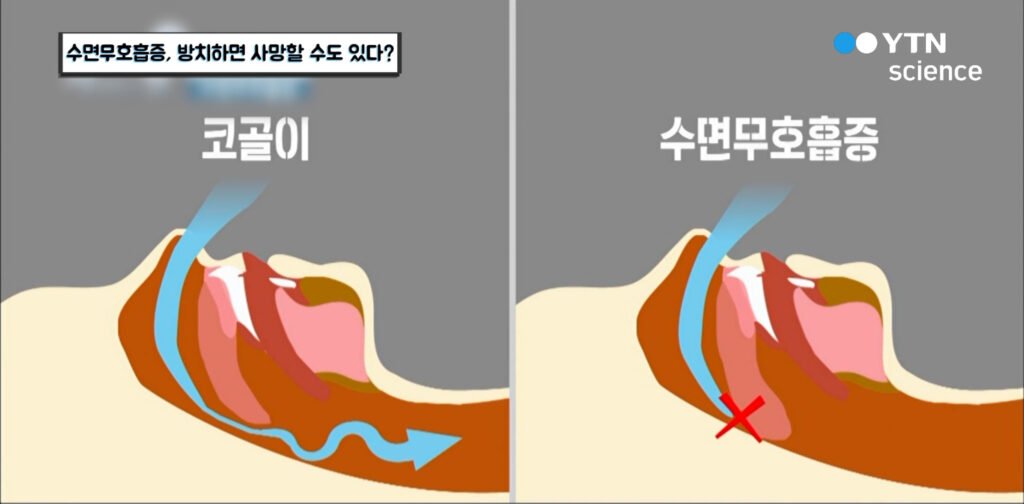 수면무호흡증